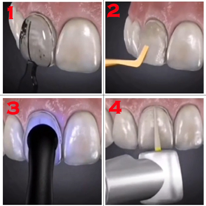 Cetakan Veneer Gigi yang Dapat - Teeth Whitening Moulds ulasan dan harga